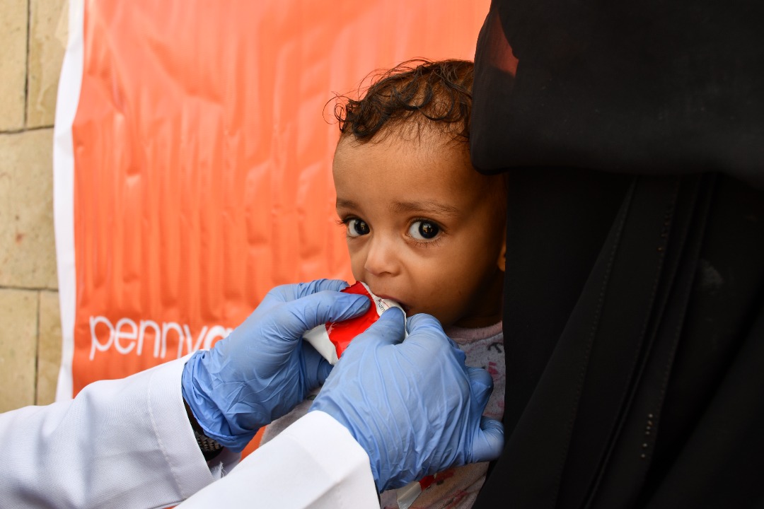 سوء التغذية الحاد الوخيم SAM